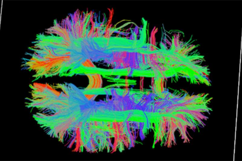 Colorful fMRI imag of the brain.